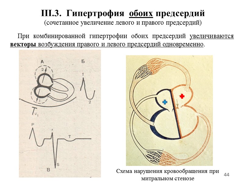 44 III.3. Гипертрофия обоих предсердий (сочетанное увеличение левого и правого предсердий) 44 III.3. Гипертрофия обоих предсердий (сочетанное увеличение левого и правого предсердий)